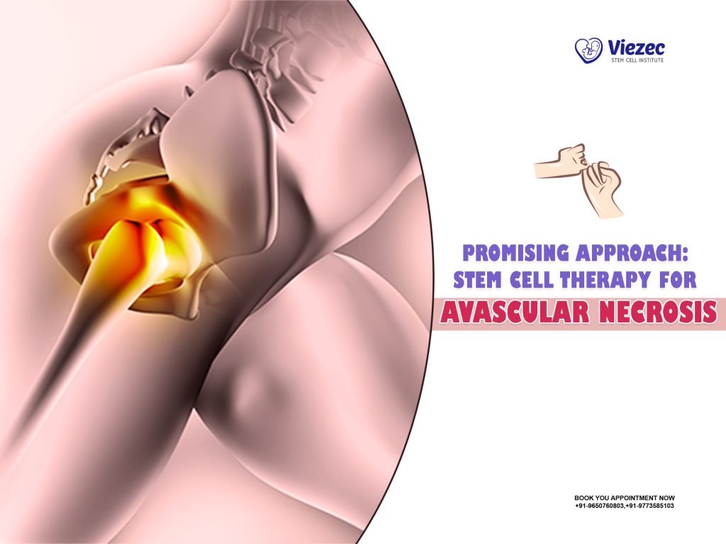 Promising Approach: Stem Cell Therapy for Avascular Necrosis