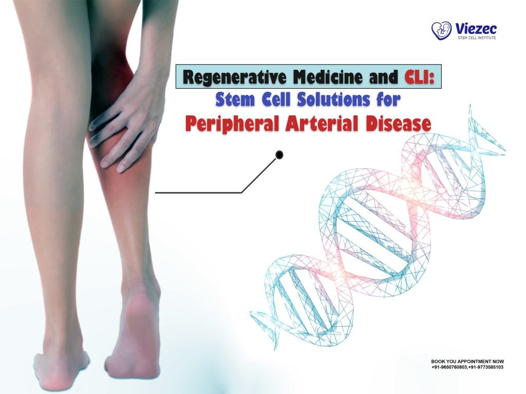 Regenerative Medicine and CLI: Stem Cell Solutions for Peripheral Arterial Disease