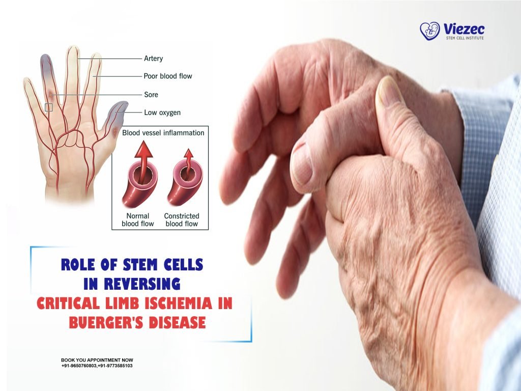 Role of Stem Cells in Reversing Critical Limb Ischemia in Buerger's Disease