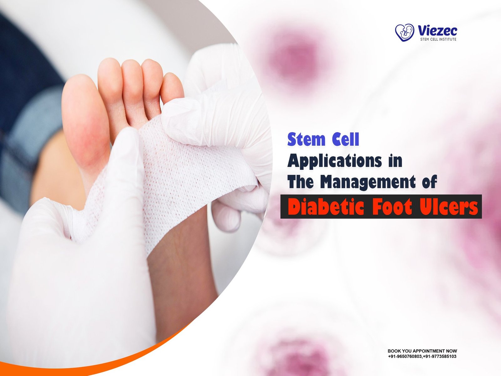 Stem Cell Applications in the Management of Diabetic Foot Ulcers