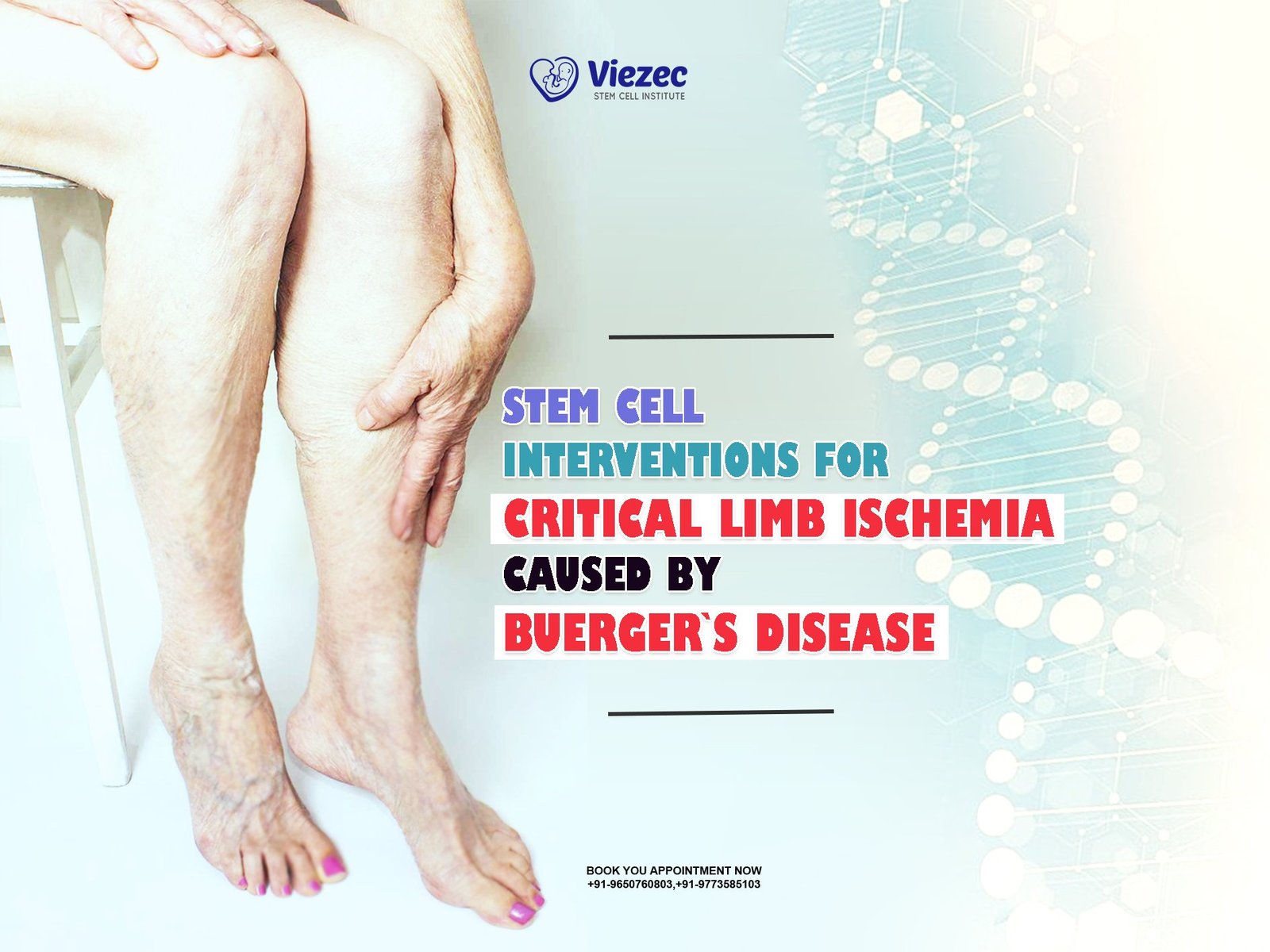 Stem Cell Interventions for Critical Limb Ischemia Caused by Buerger's Disease