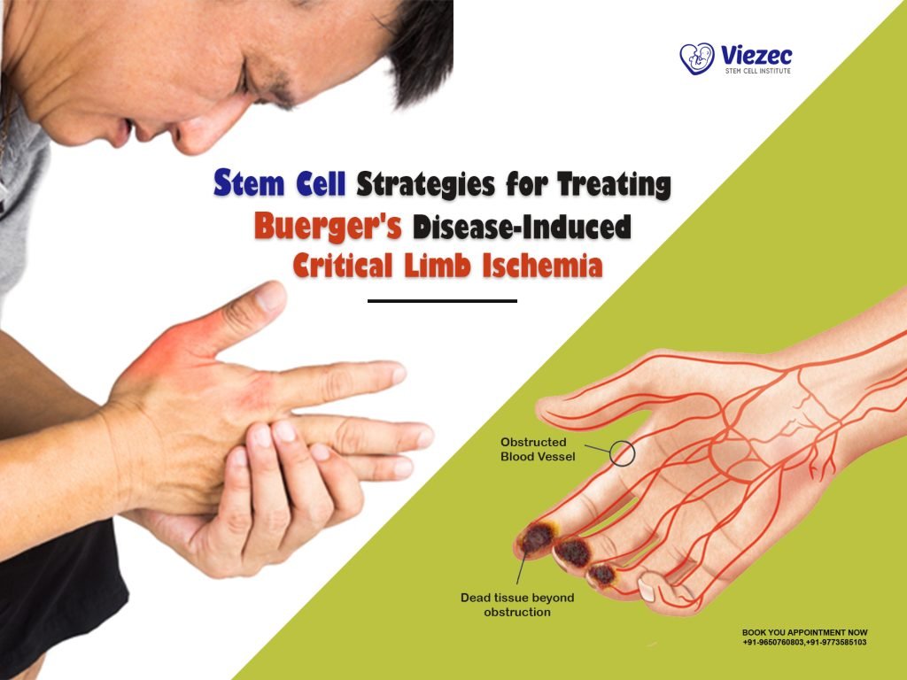 Stem Cell Strategies for Treating Buerger's Disease-Induced Critical Limb Ischemia