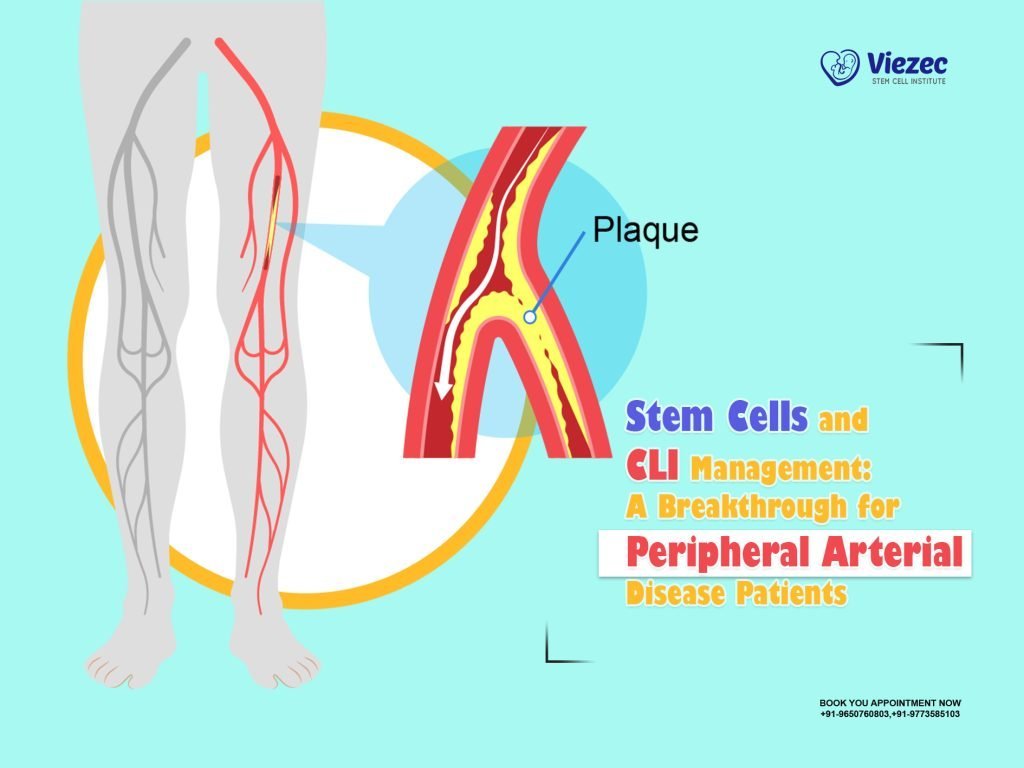 Stem Cells and CLI Management: A Breakthrough for Peripheral Arterial Disease Patients