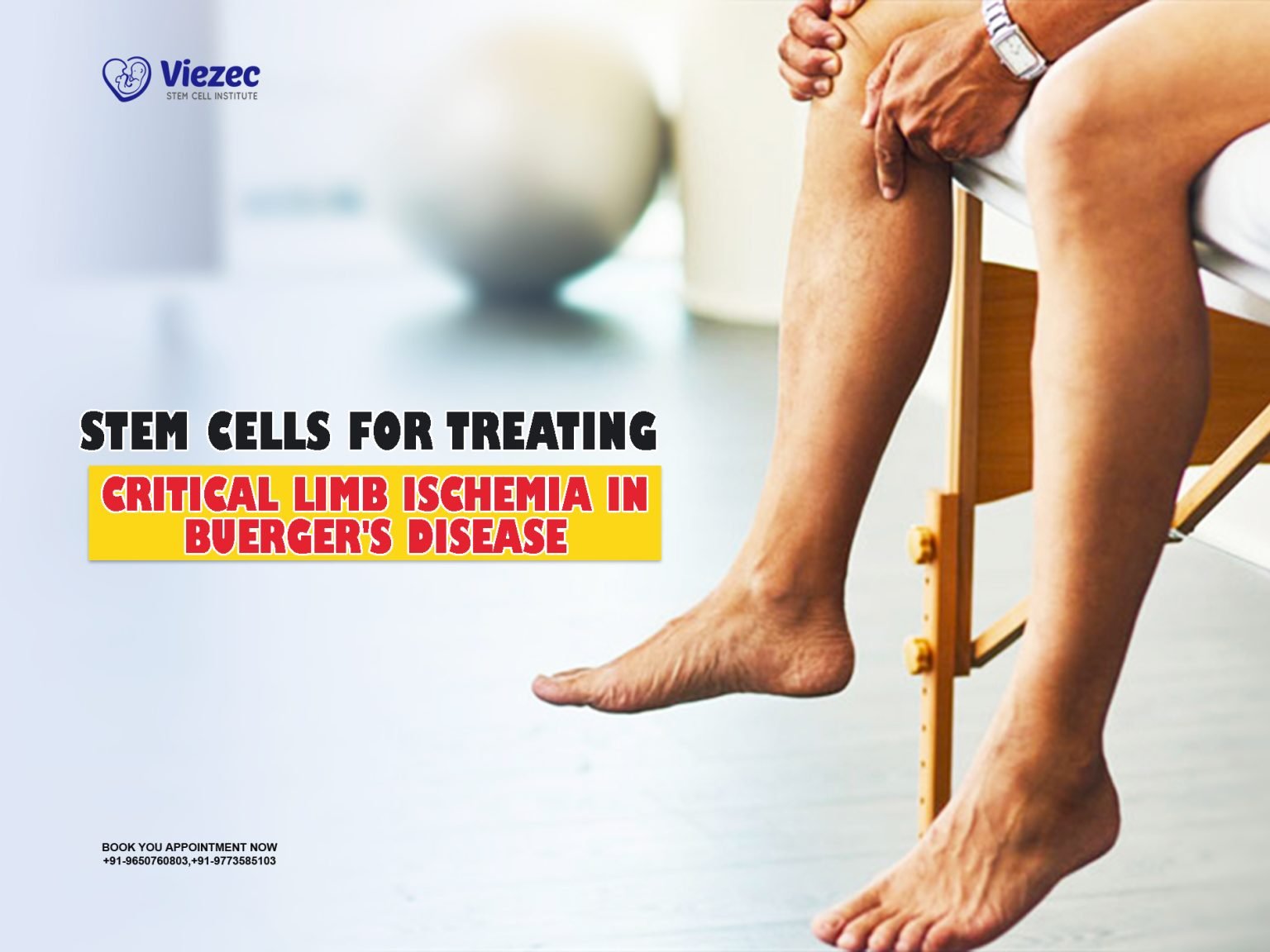 Stem Cells For Treating Critical Limb Ischemia In Buerger's Disease