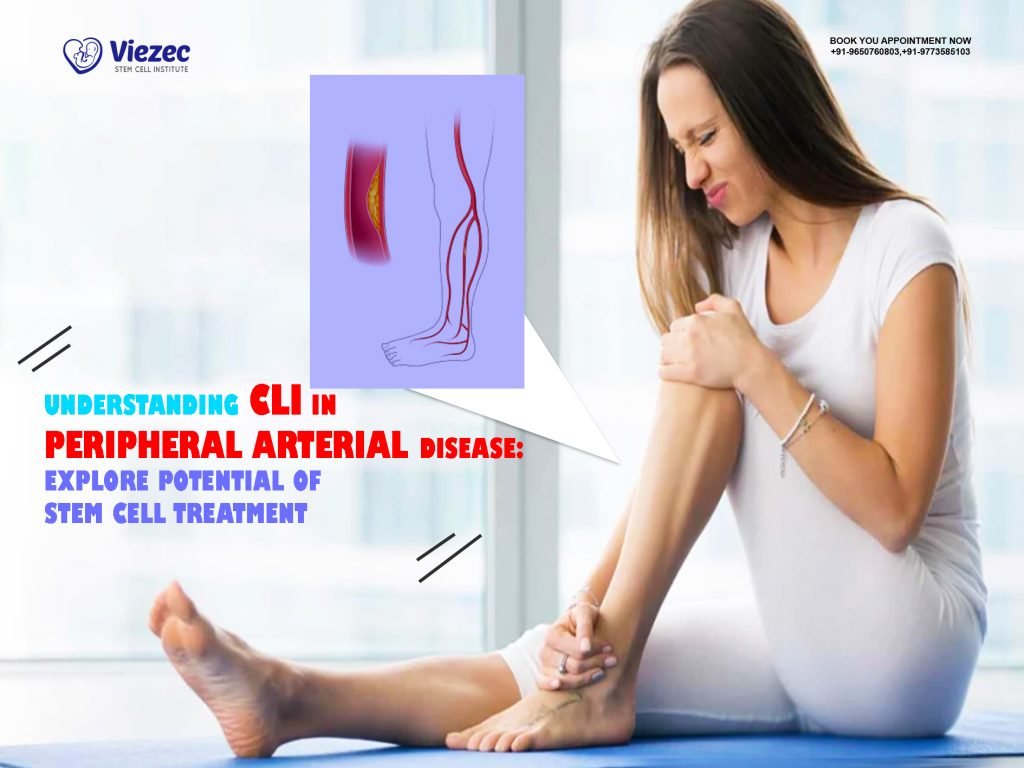 Understanding CLI in Peripheral Arterial Disease: Explore Potential of Stem Cell Treatments