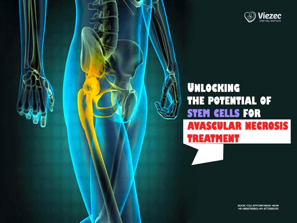 Stem Cells for Avascular Necrosis Treatment