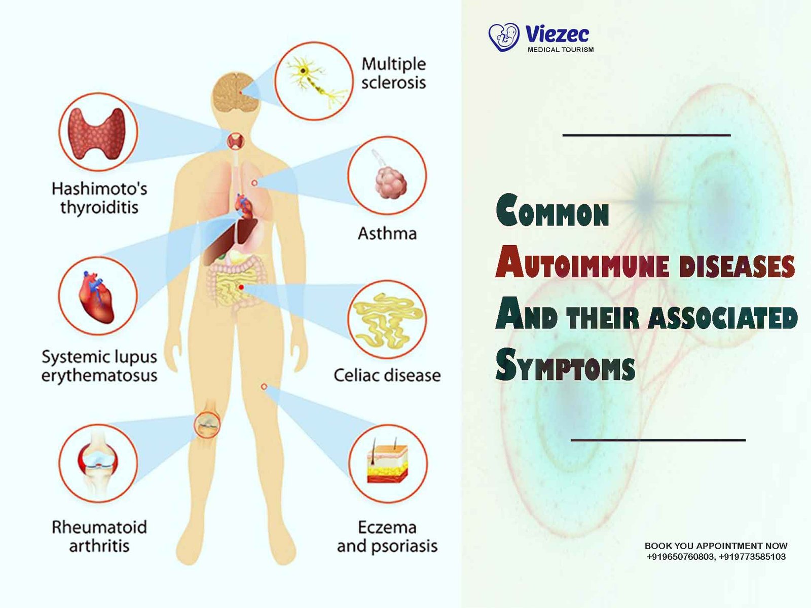 Common Autoimmune Diseases