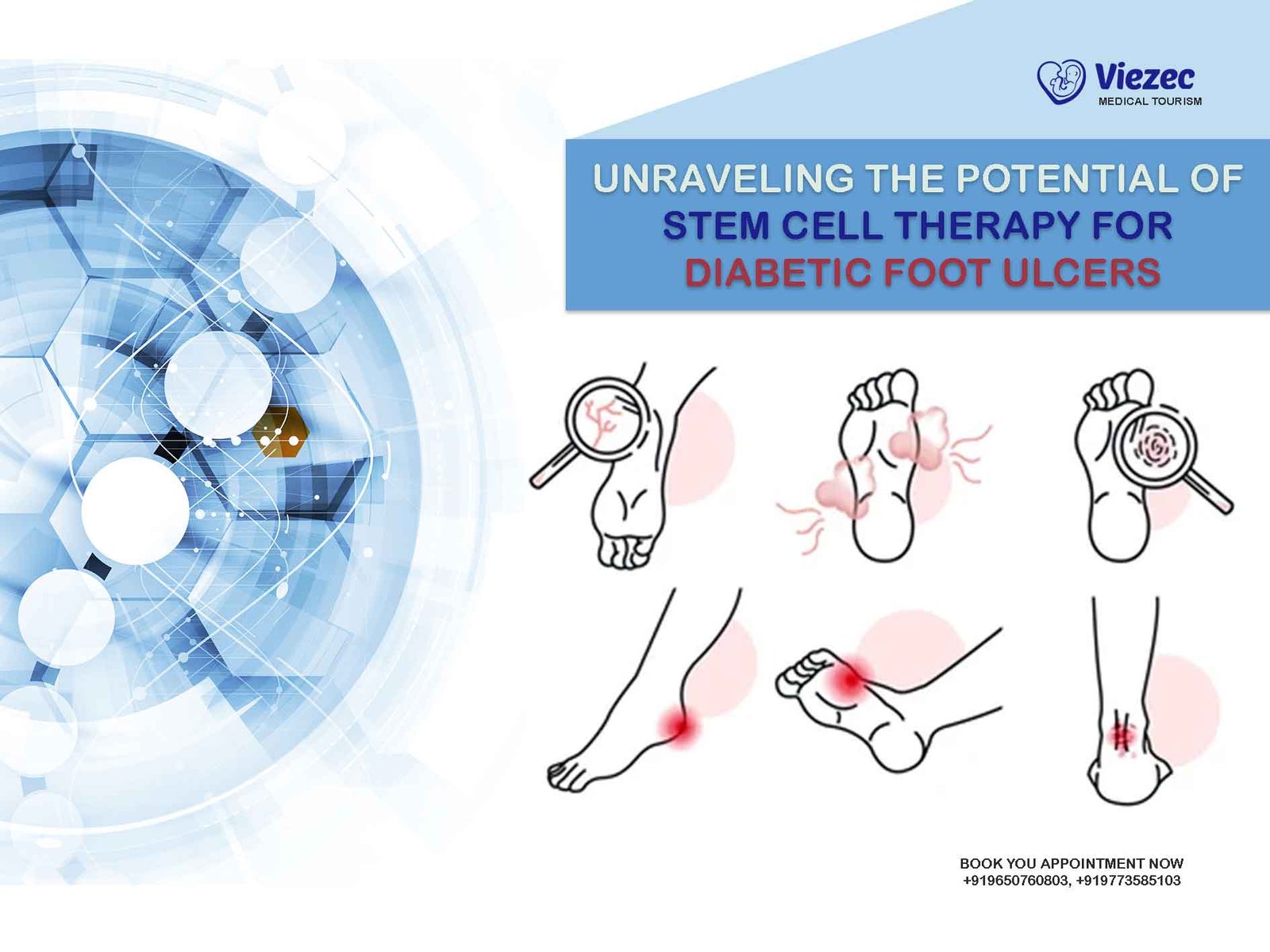 Diabetic Foot Ulcers