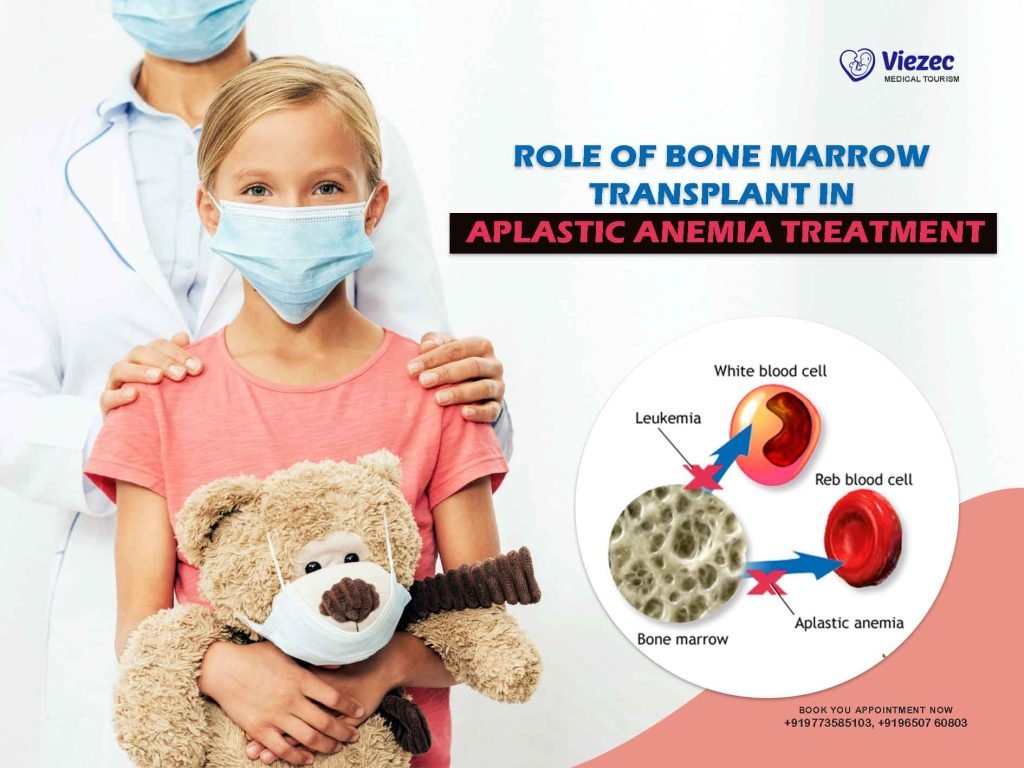 Role of Bone Marrow Transplant in Aplastic Anemia Treatment