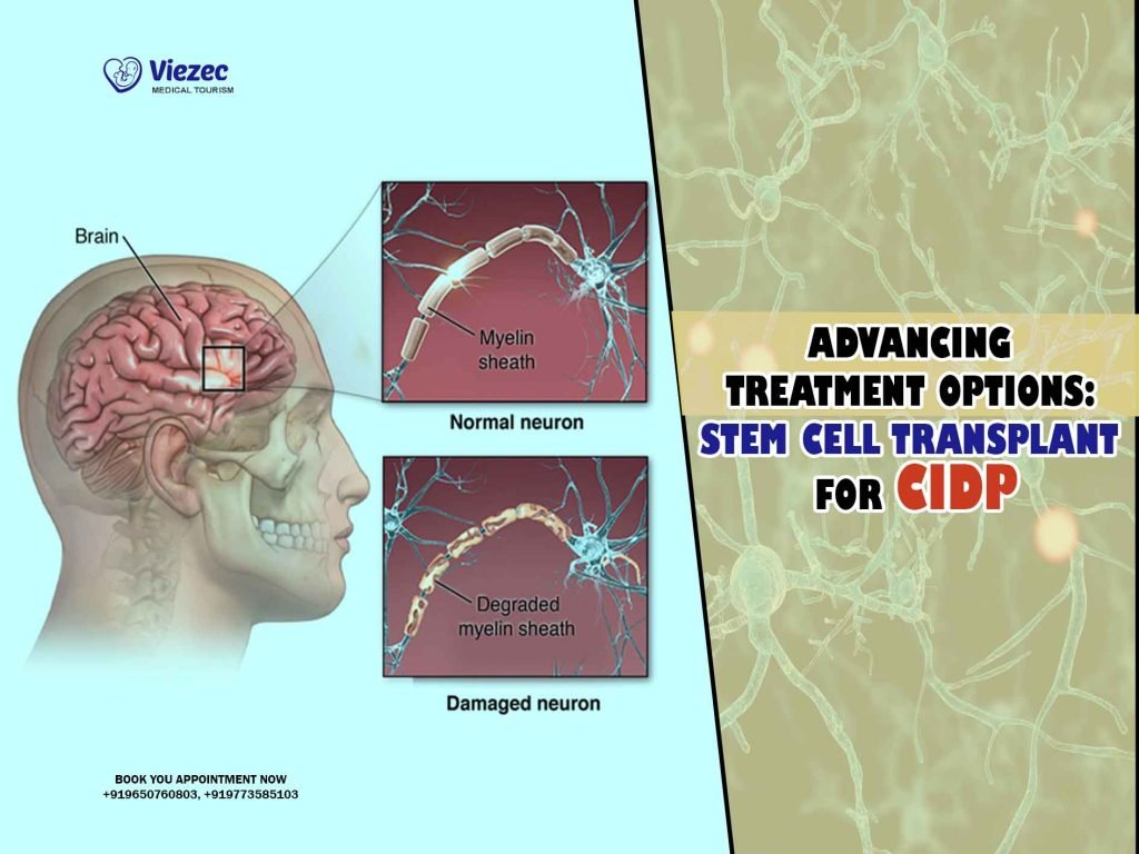 Advancing Treatment Options: Stem Cell Transplant for CIDP