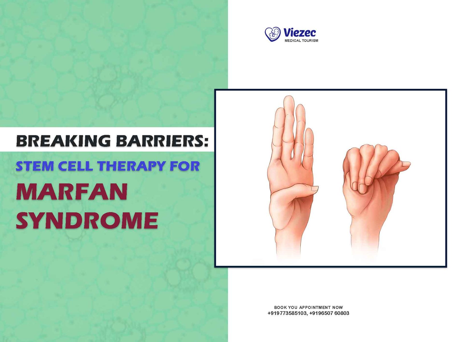 Breaking Barriers: Stem Cell Therapy for Marfan Syndrome