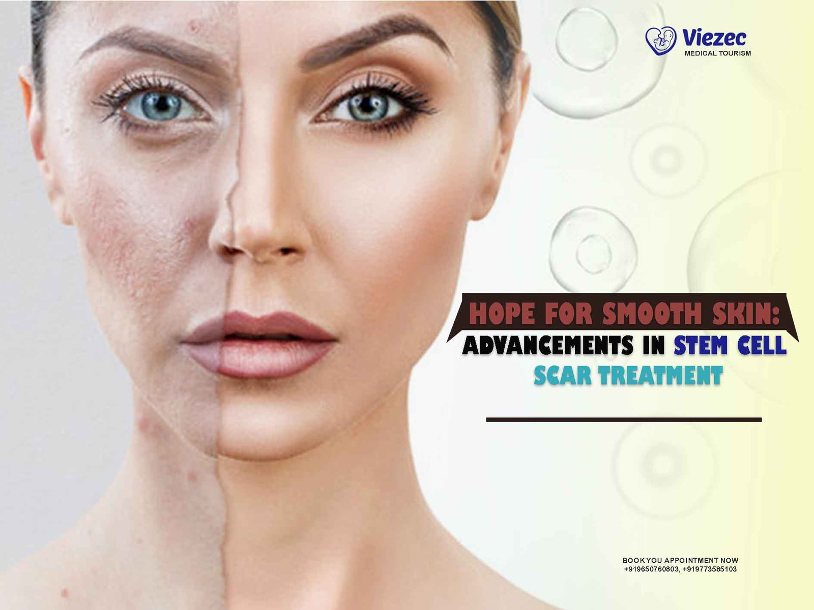 stem cell scar treatment