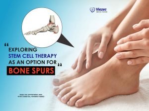 Exploring Stem Cell Therapy as an Option for Bone Spurs
