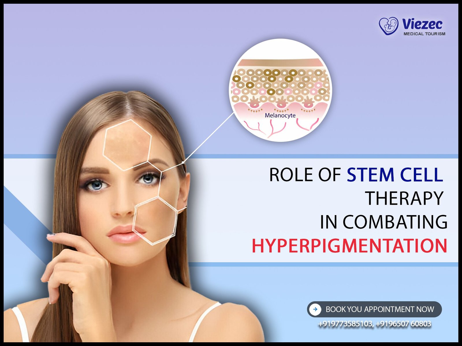 Stem Cell Therapy in Combating Hyperpigmentation
