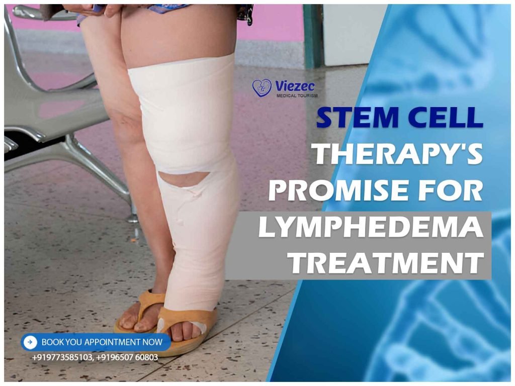 Stem Cell Therapy's Promise for Lymphedema Treatment
