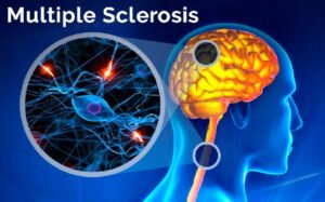 Illustration showing a human brain and spinal cord with highlighted areas, a close-up of damaged nerve cells, and the title Multiple Sclerosis.