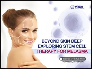 Beyond Skin Deep: Exploring Stem Cell Therapy for Melasma