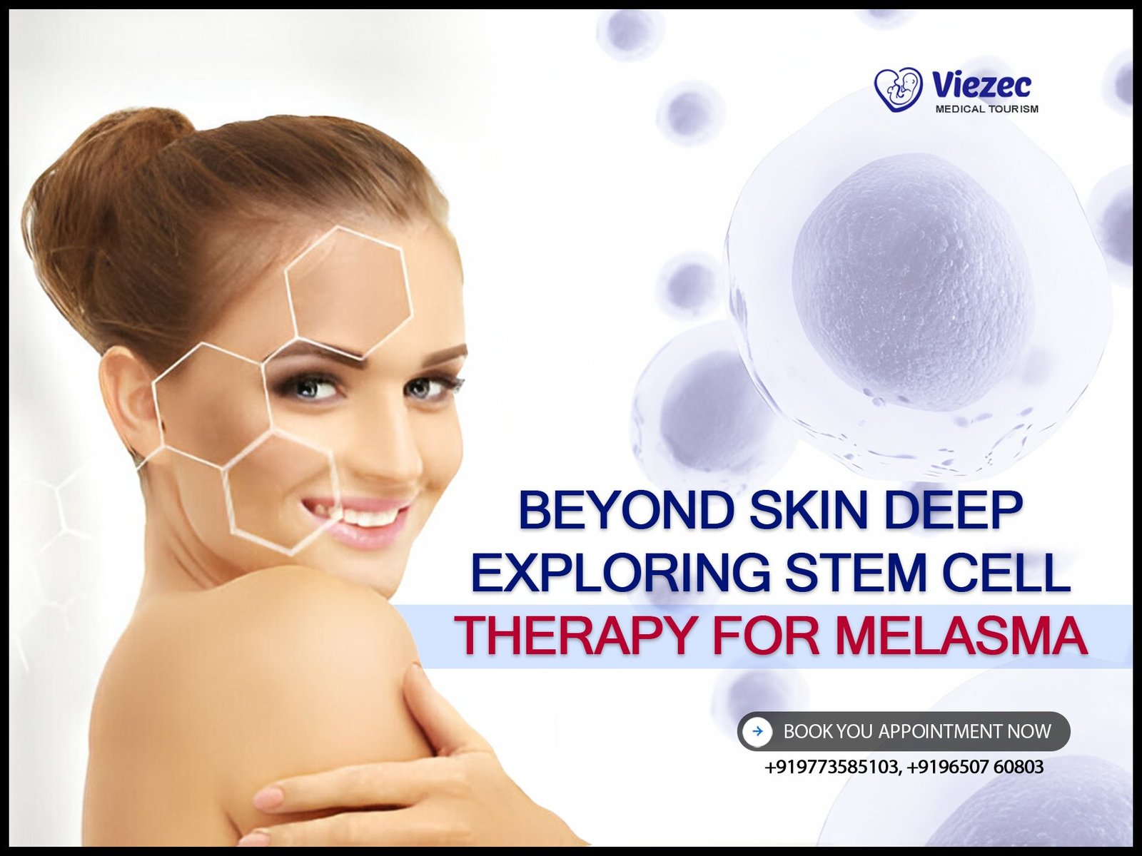 Beyond Skin Deep: Exploring Stem Cell Therapy for Melasma