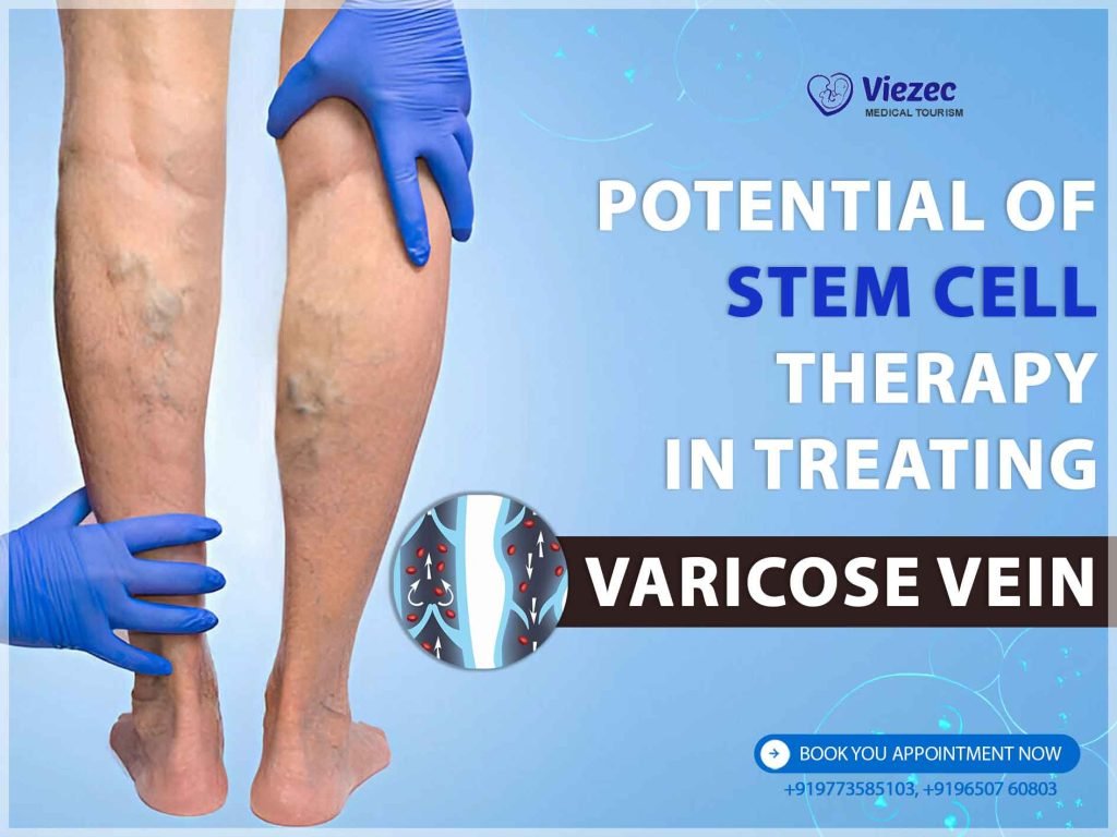 Varicose Veins