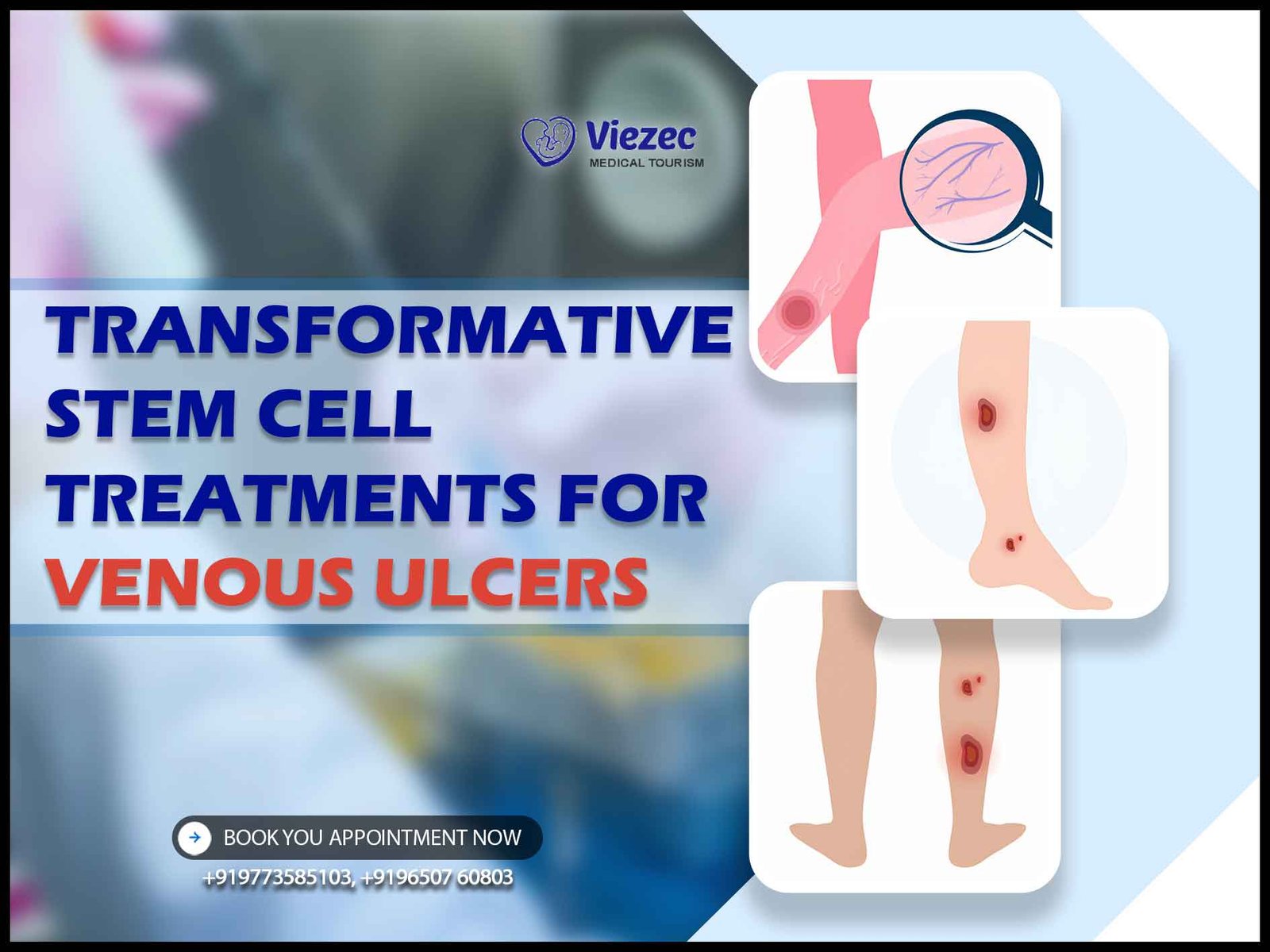 Venous Ulcers