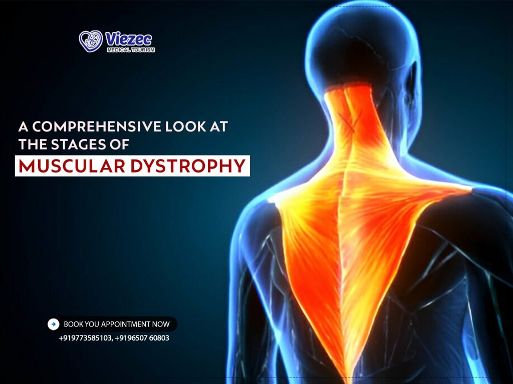 A Comprehensive Look at the Stages of Muscular Dystrophy