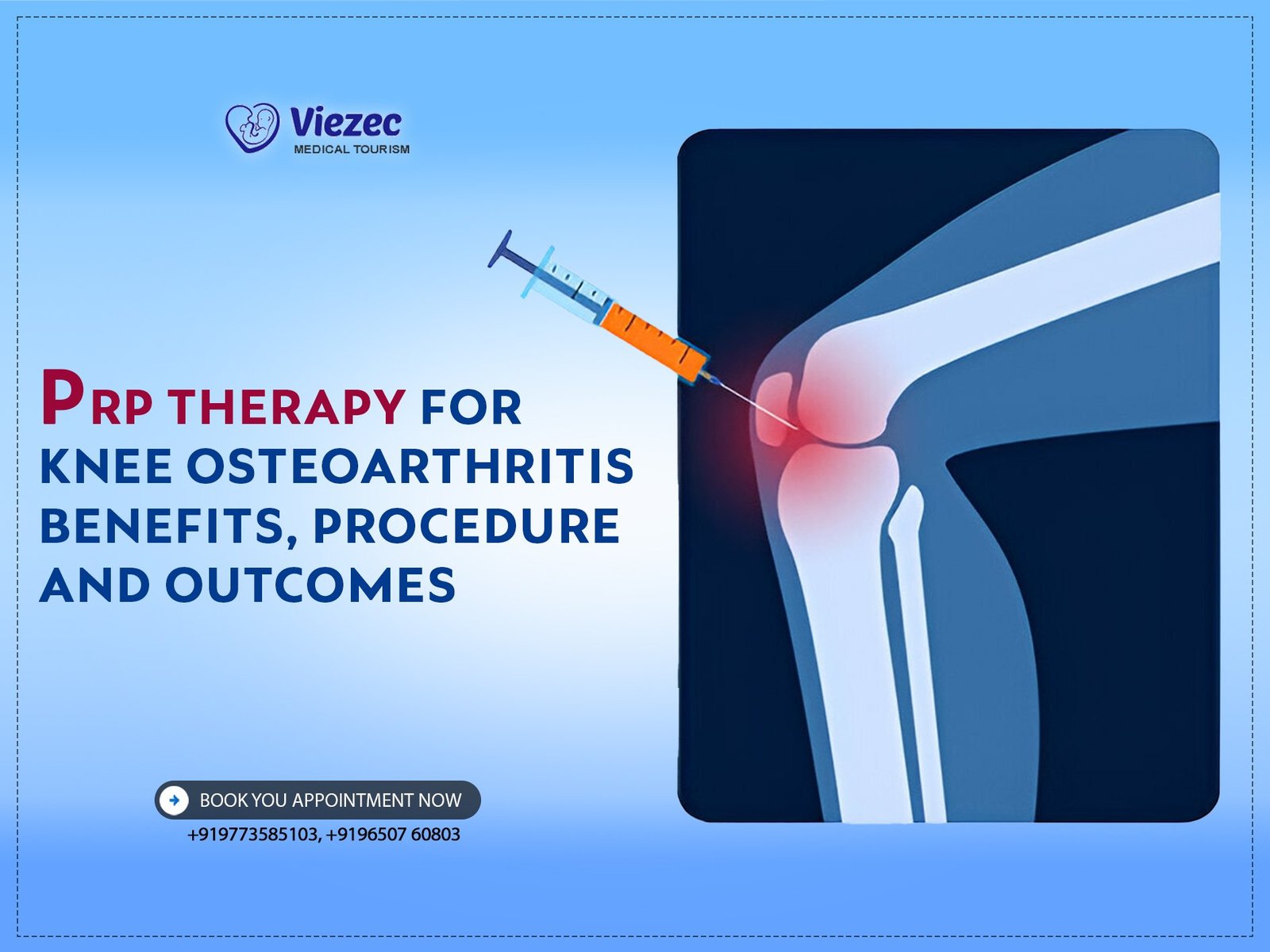 PRP Therapy for Knee Osteoarthritis