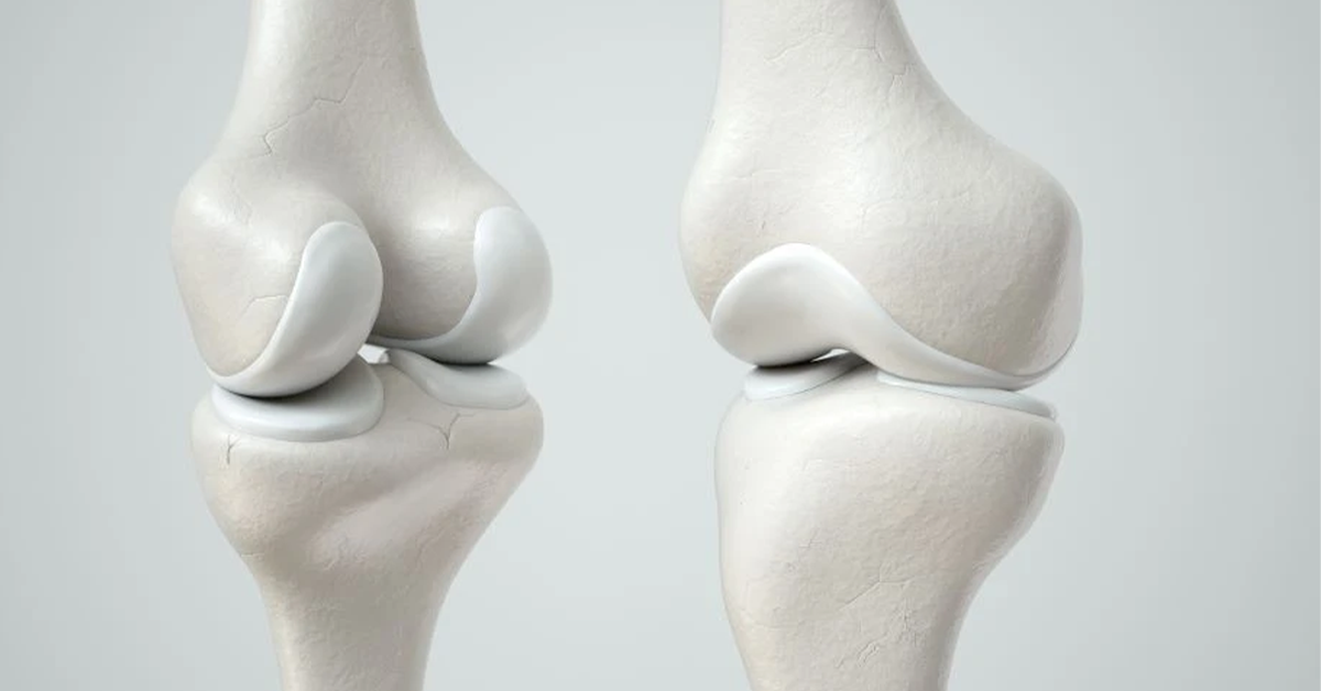 illustrative image of Cartilage Repair