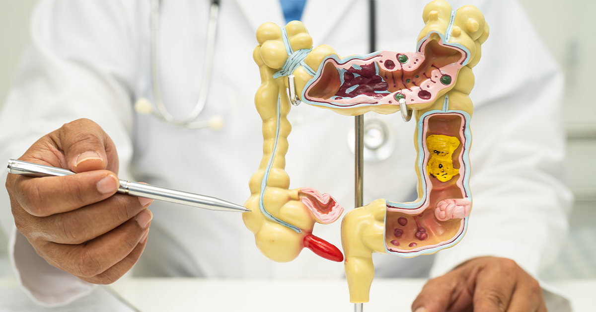 Crohn’s Disease Illustrative Image