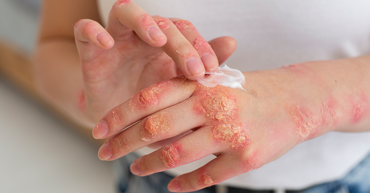 psoriasis image