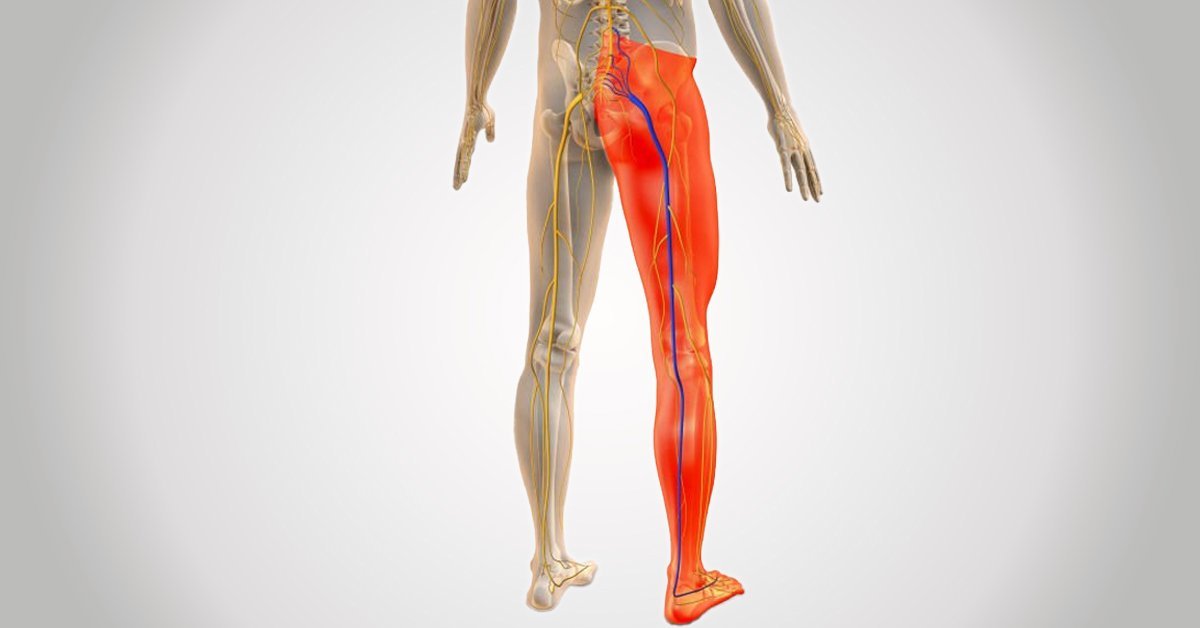 Illustrative image of sciatic nerve injury