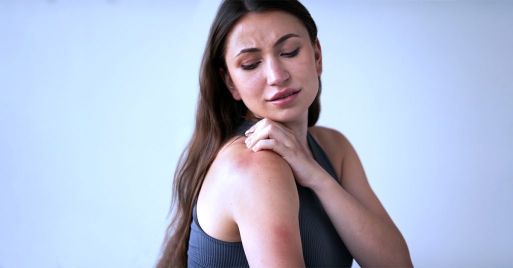 exosome for skin burns