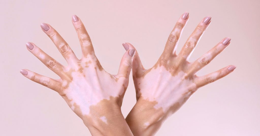 exosome for vitiligo