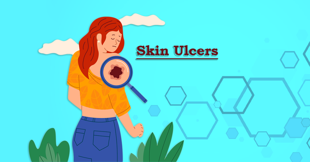 skin ulcer