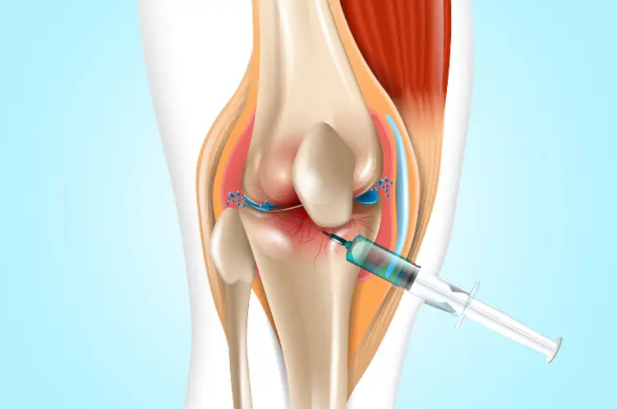 Intra-articular Injection