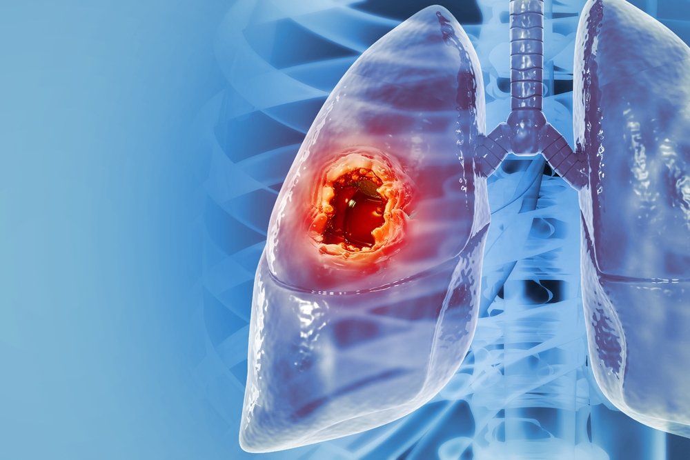 Immunotherapy for Lung Cancer