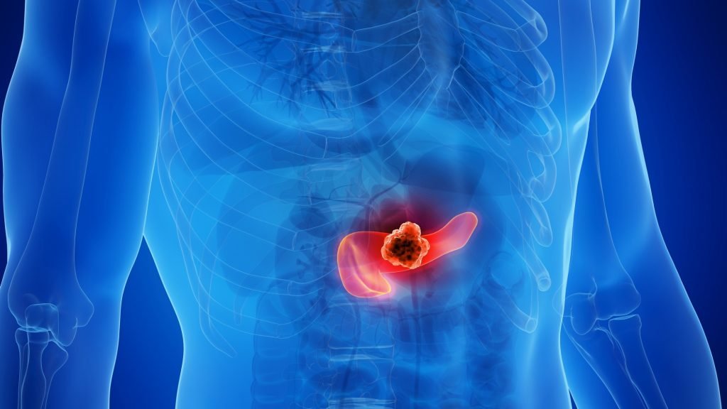 Immunotherapy for Pancreatic Cancer