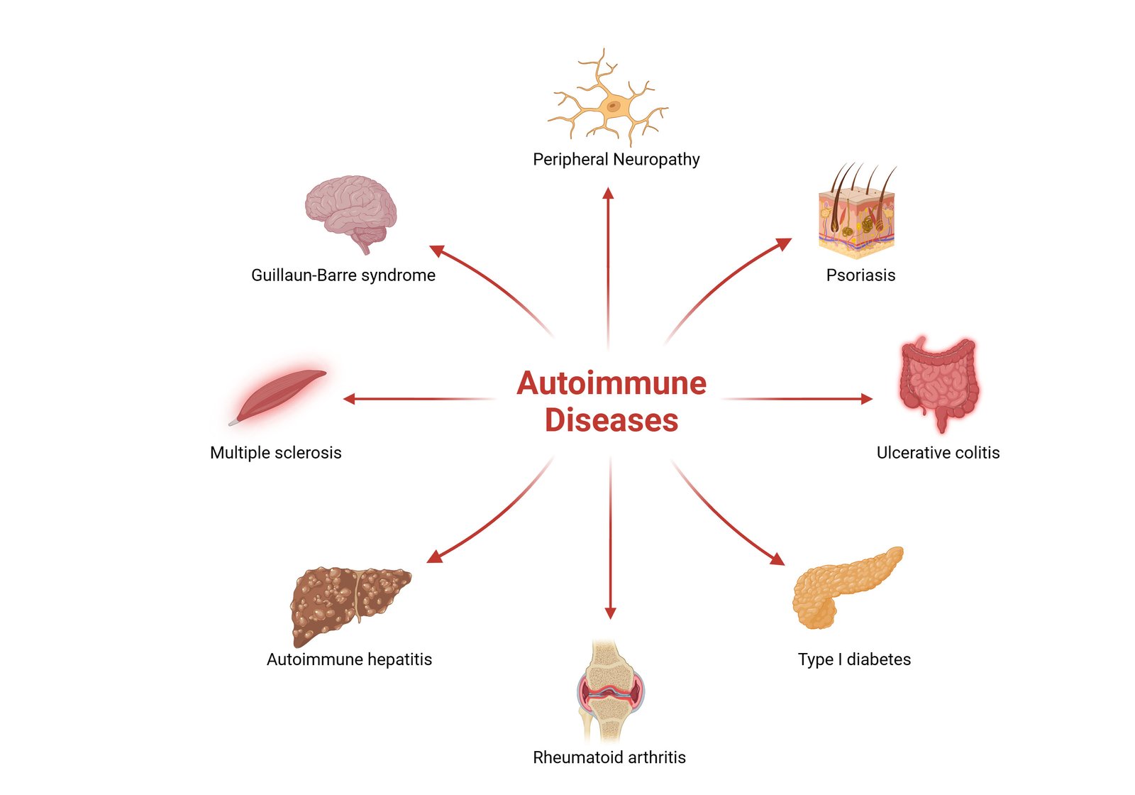 MSC therapy for autoimmune and inflammatory diseases