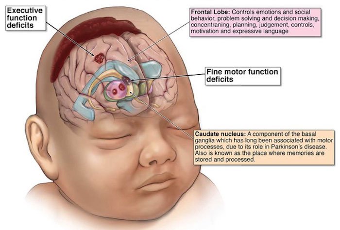 Image showing brain damage caused by Hypoxic Ischemic Encephalopathy due to lack of oxygen and blood flow.