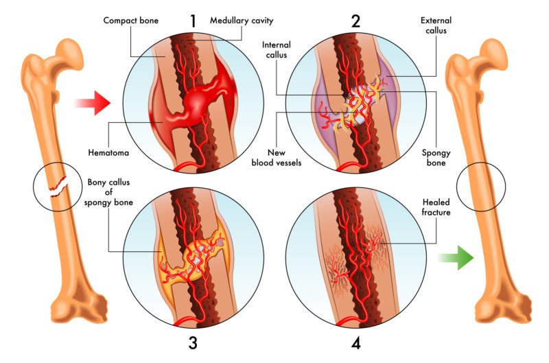 Illustration showing stages of bone healing after fracture – inflammation, soft callus, hard callus, and bone remodeling.