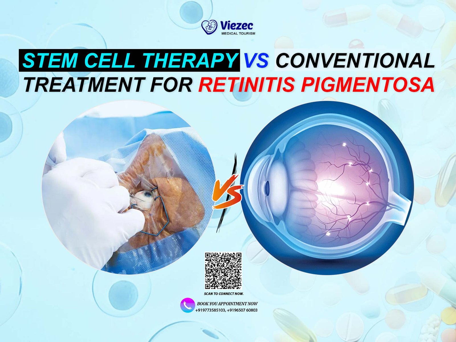 Comparison of stem cell therapy and conventional treatment for retinitis pigmentosa with eye surgery and retina diagram