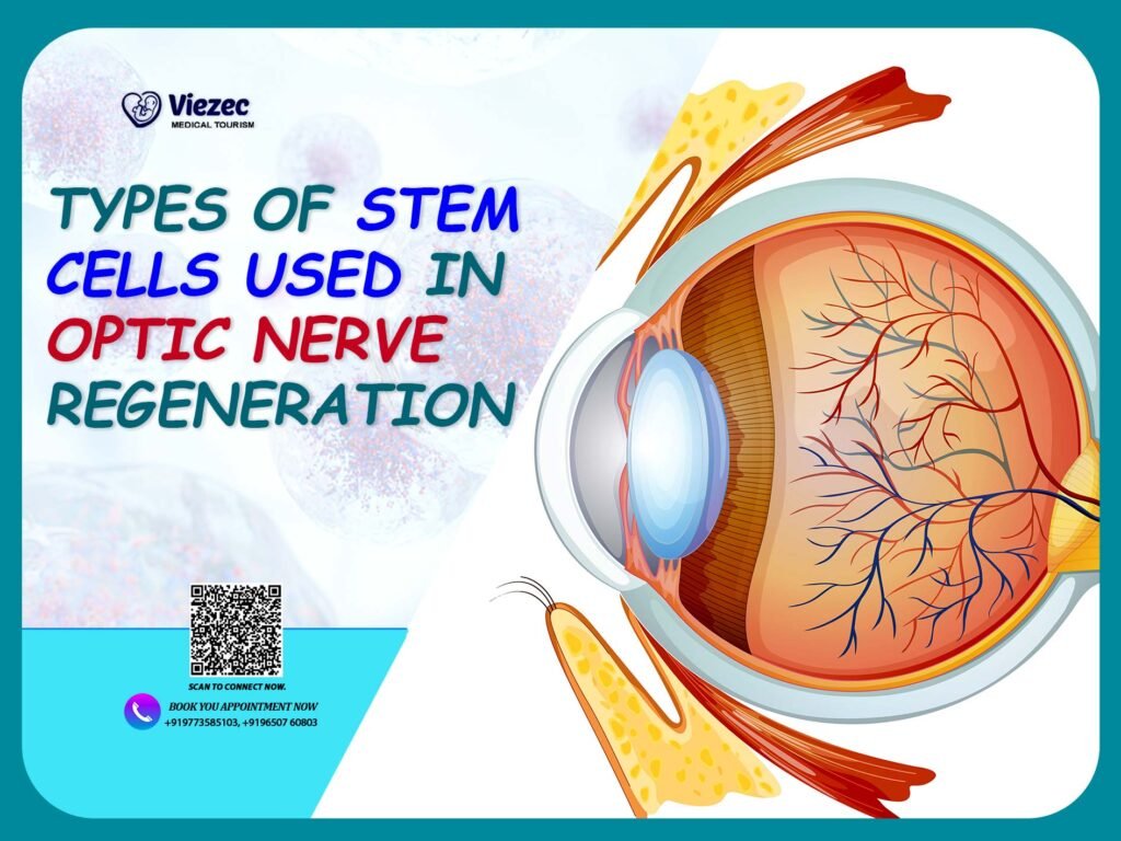 Types of stem cells used in optic nerve regeneration illustrated with eye anatomy diagram for stem cell therapy research.
