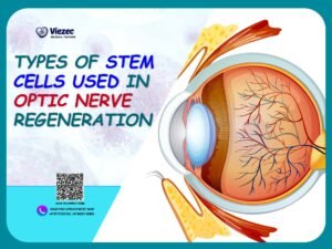 Types of stem cells used in optic nerve regeneration illustrated with eye anatomy diagram for stem cell therapy research.