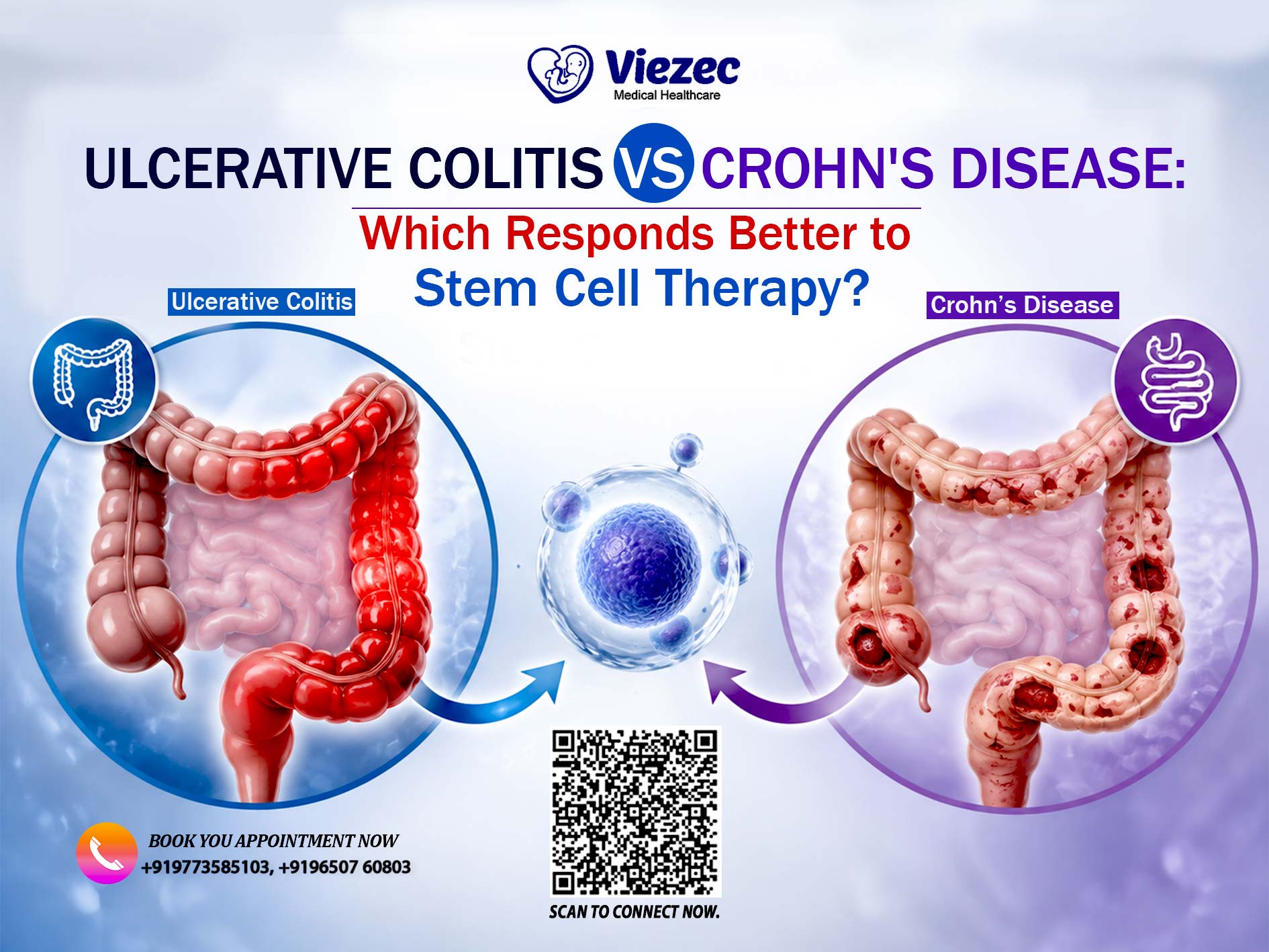 Ulcerative Colitis vs Crohn's Disease: Which Responds Better to Stem Cell Therapy?